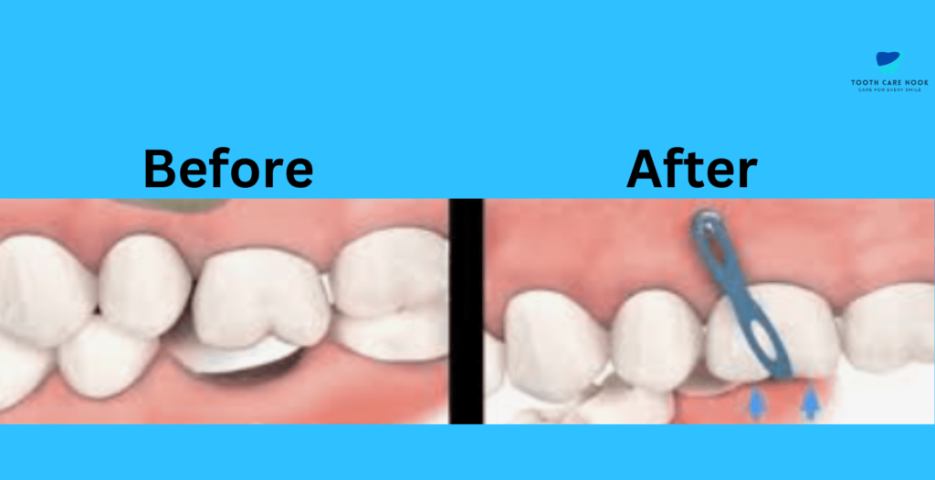 Temporary Anchorage Devices (TADs) For Braces | Know it All