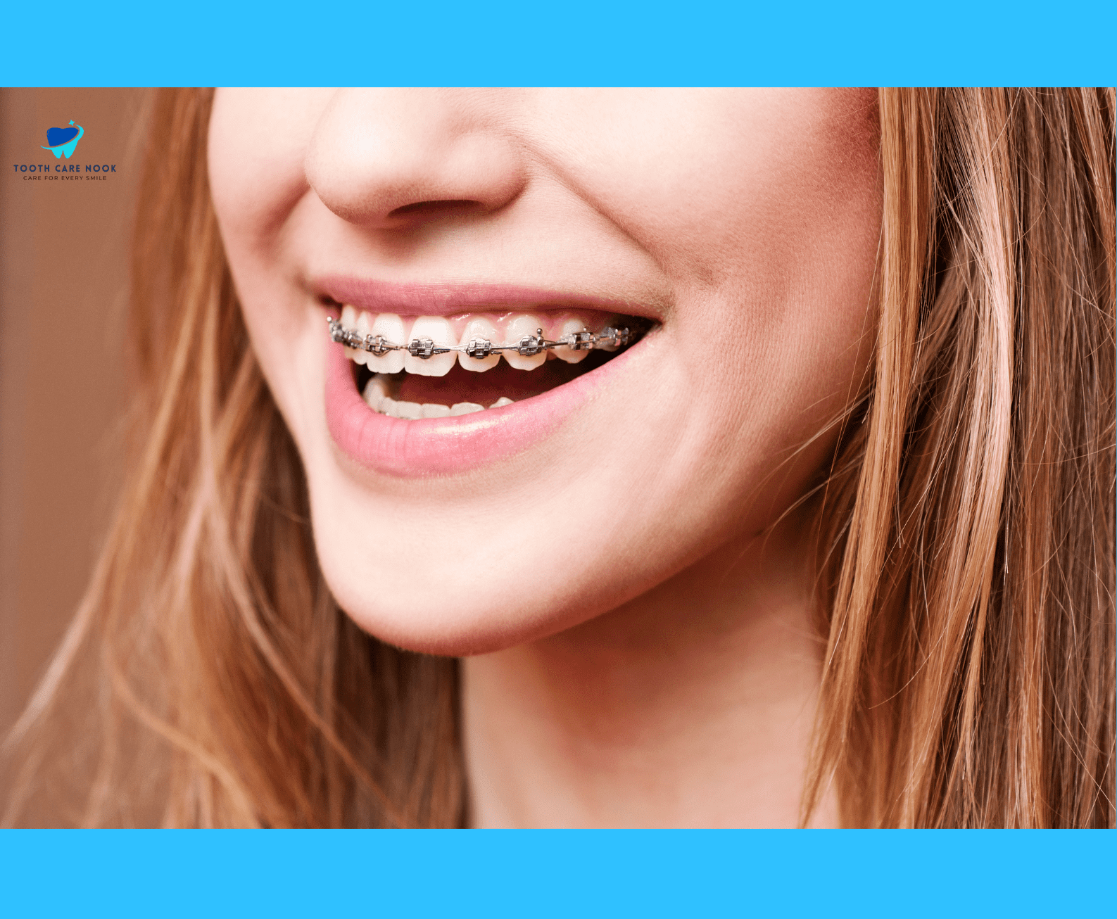 Types of Orthodontic Springs  