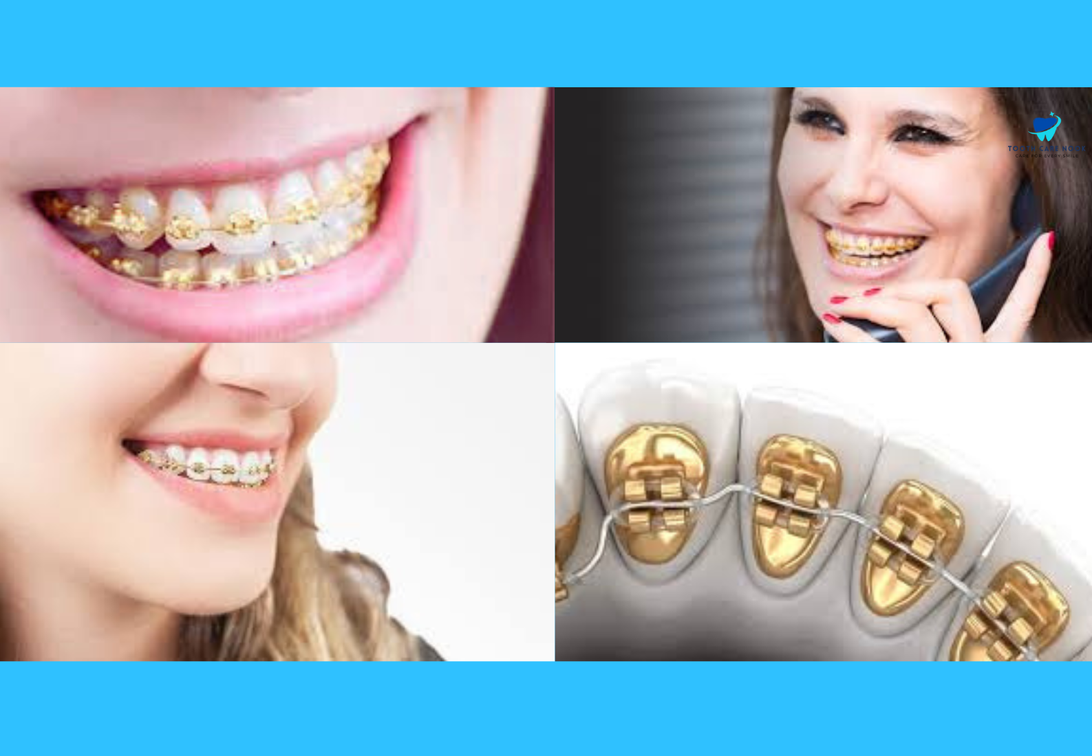 Pictures Of Gold Braces