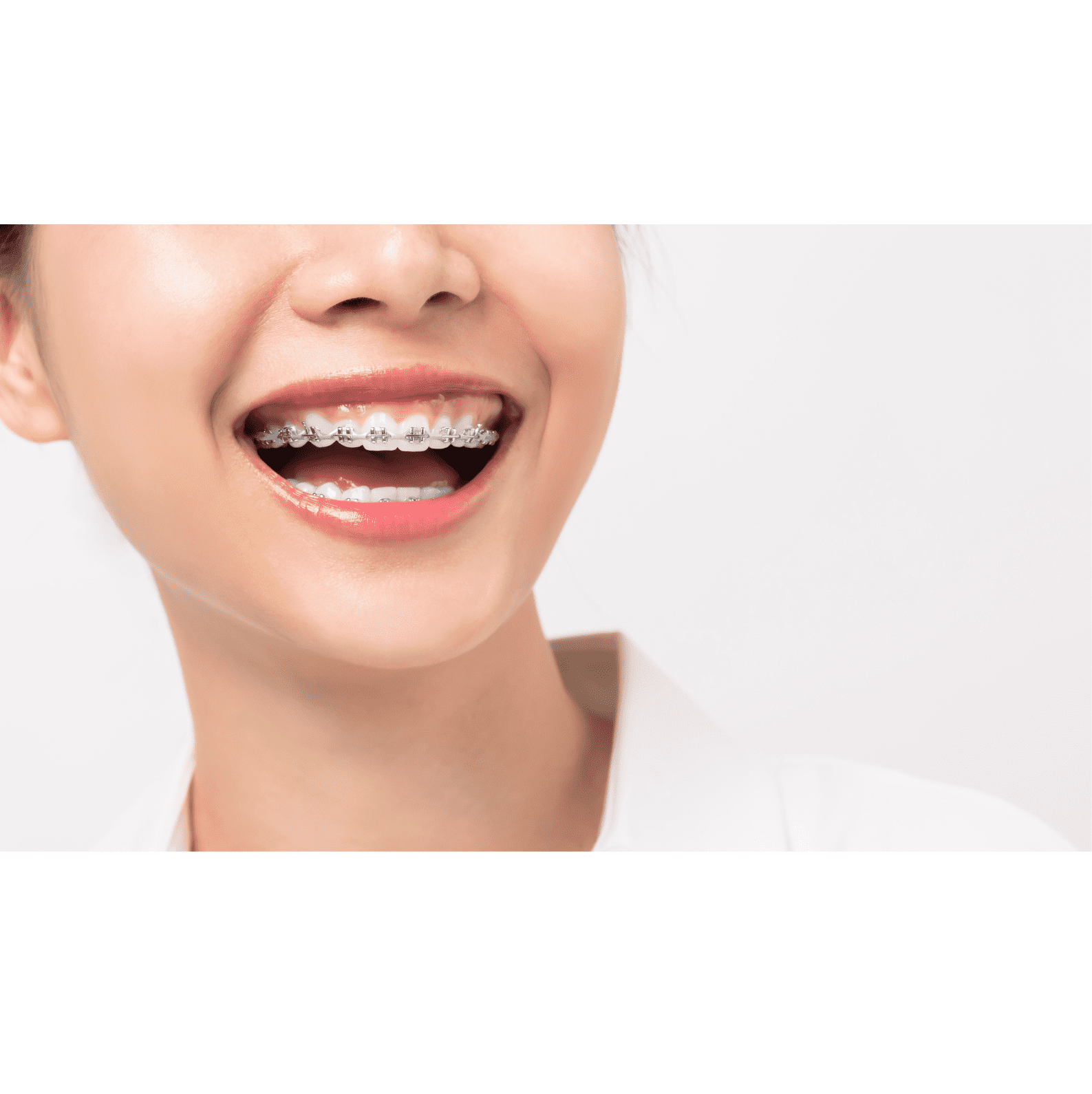 What Are Coil Springs For Braces? Purpose, Types, And All