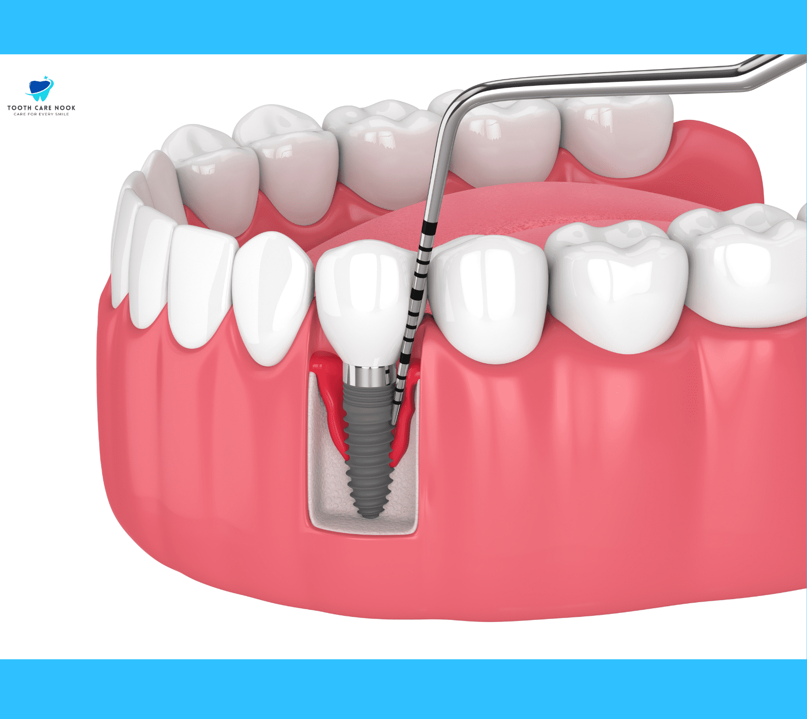 Why Would a Dental Implant Need To Be Removed  