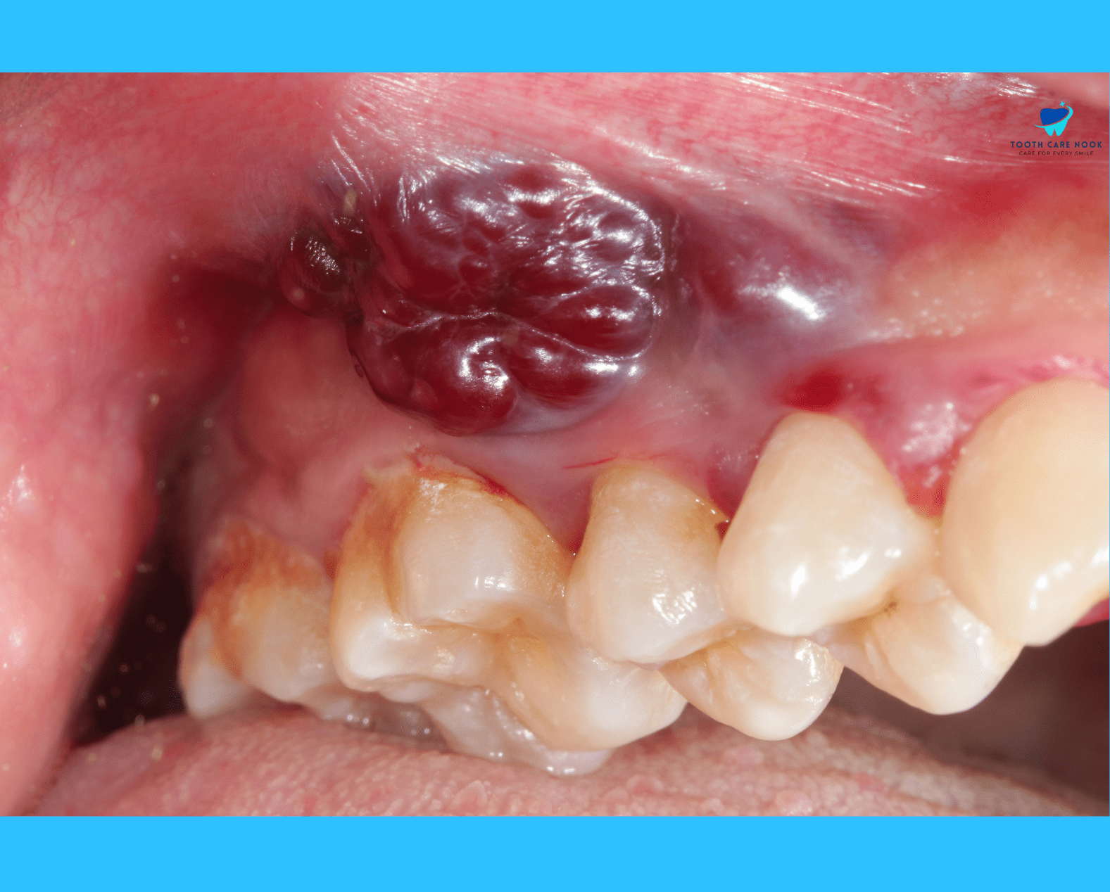 to much dental X-rays increase the risk of developing tumors