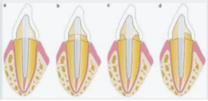 All About Ferrule Dental