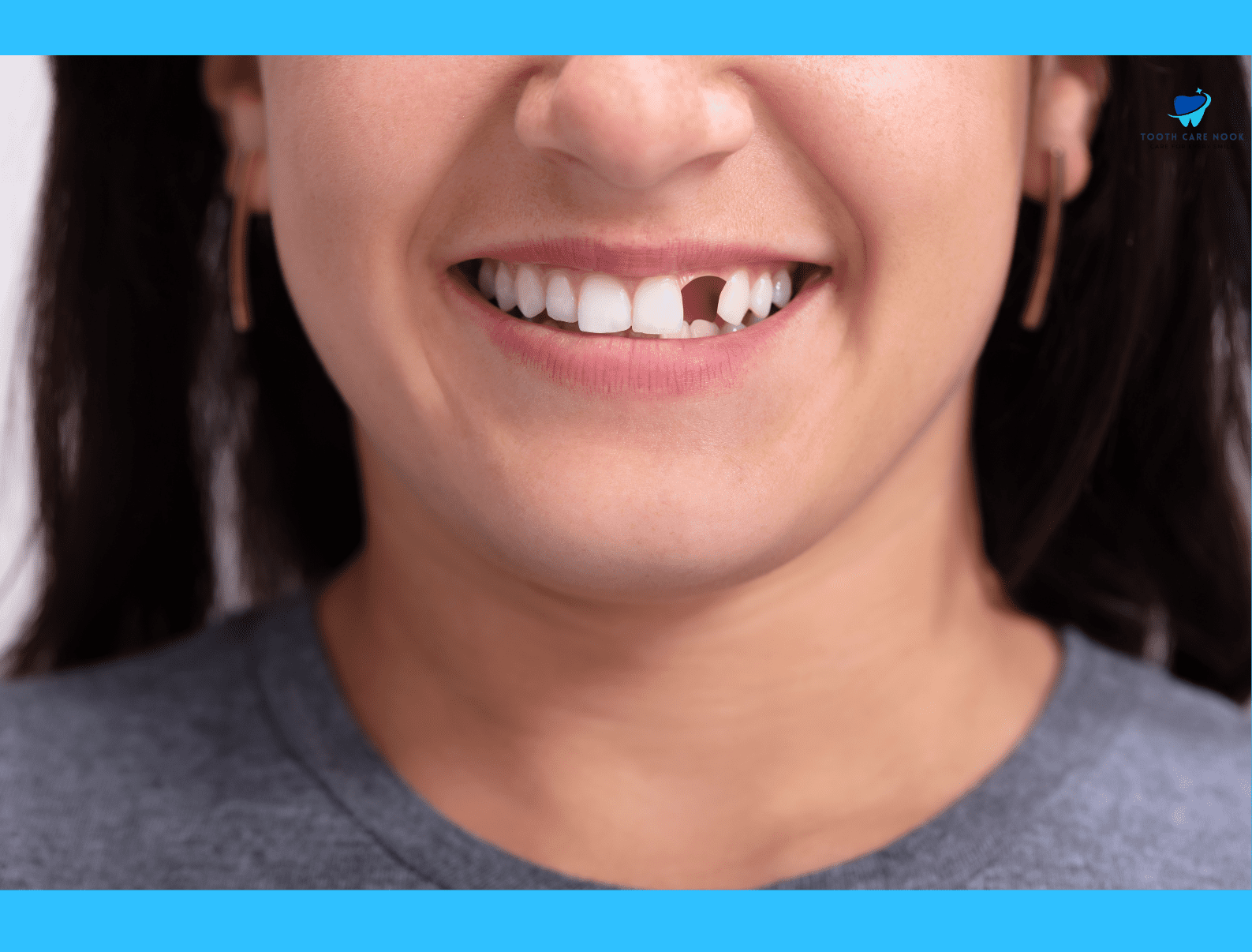 Causes of Gaps Between Teeth  