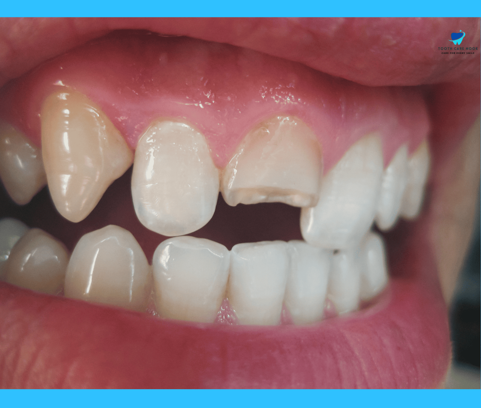 What Does A Chipped Tooth Look Like 