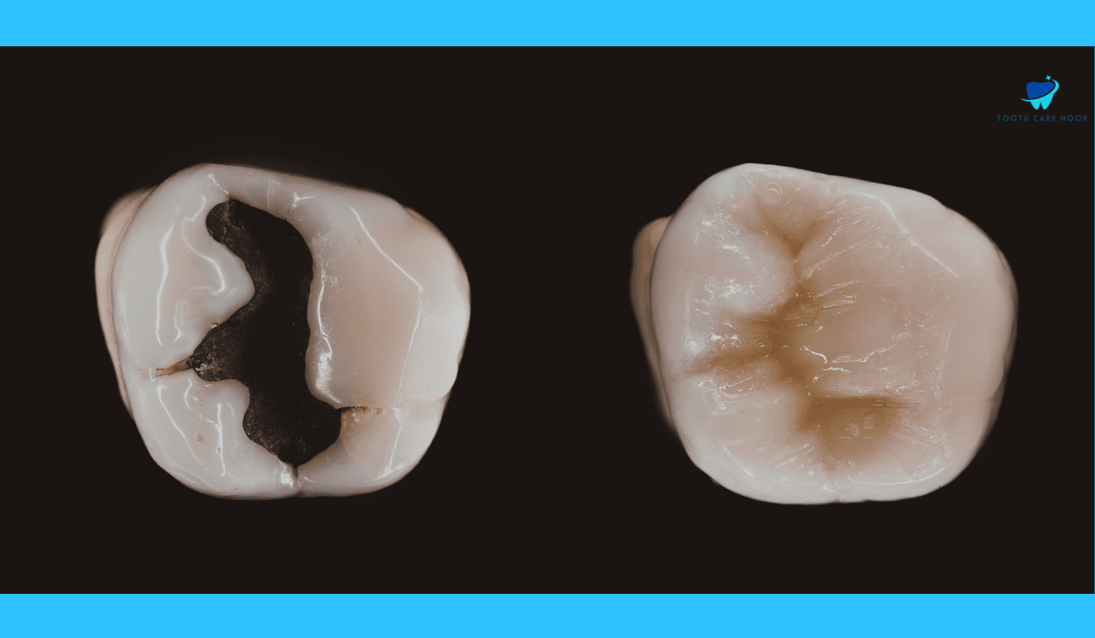 What Causes Leaking Dental Fillings | Here's What Experts Say