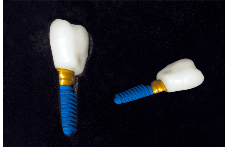 Dental Implants Loosening