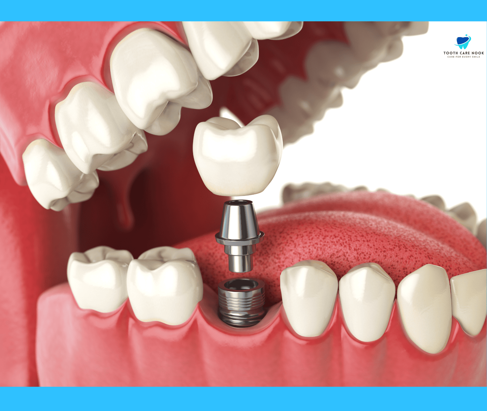 What is Healthiest Dental Implant