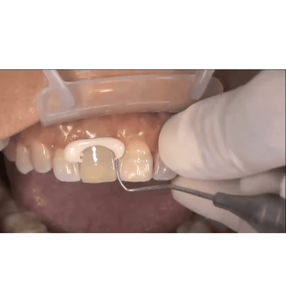 How Long Does Temporary Dental Cement Last