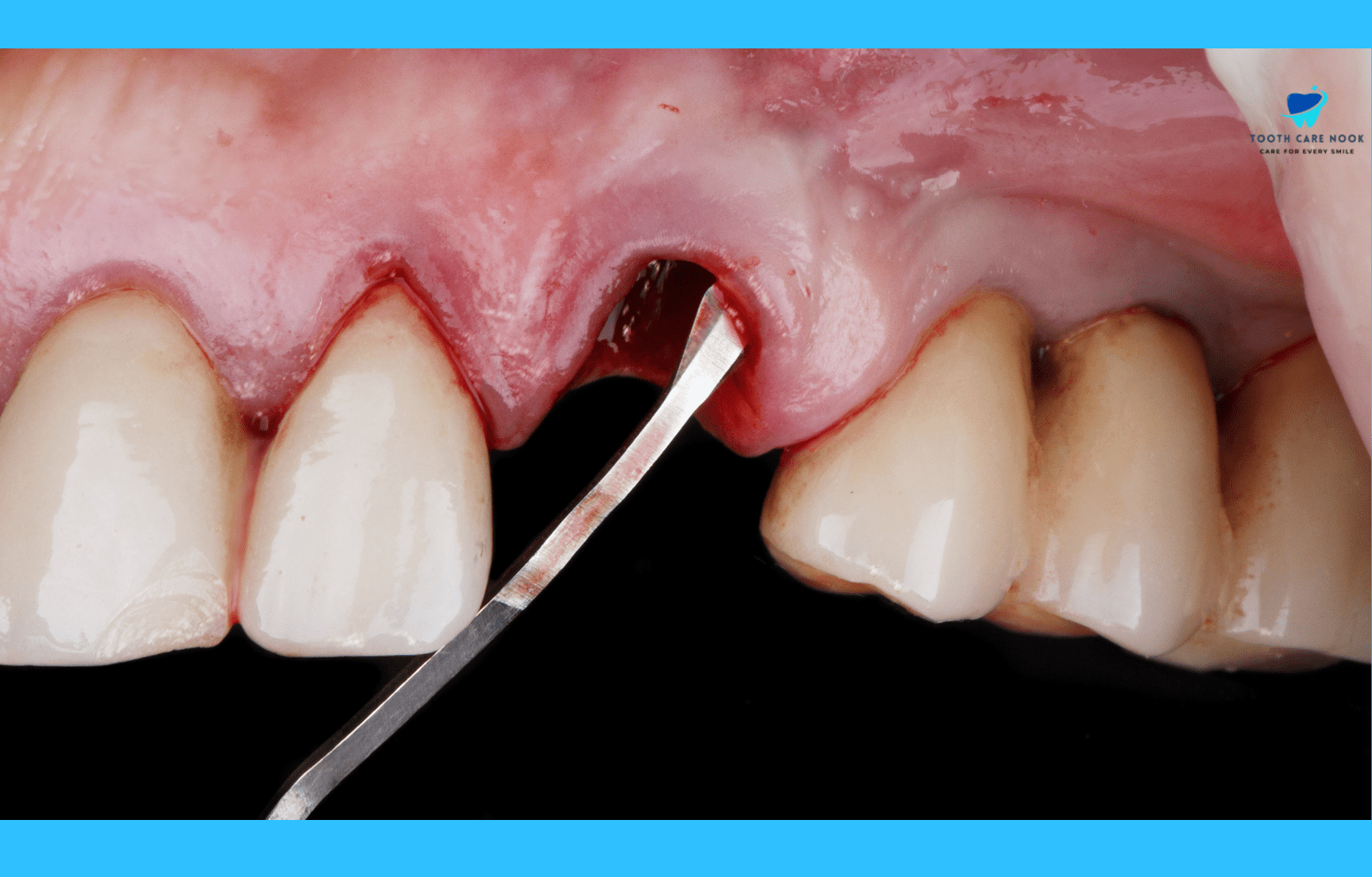 How To Tighten Gums Around Loose Tooth