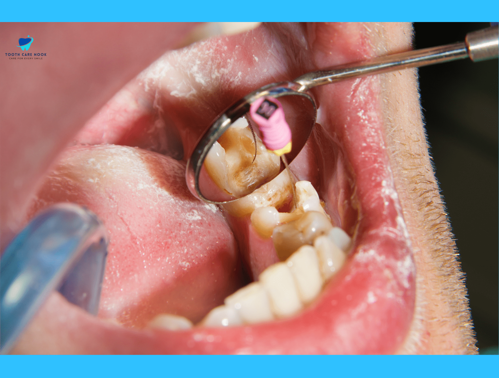 Hypocalcified Teeth Treatment