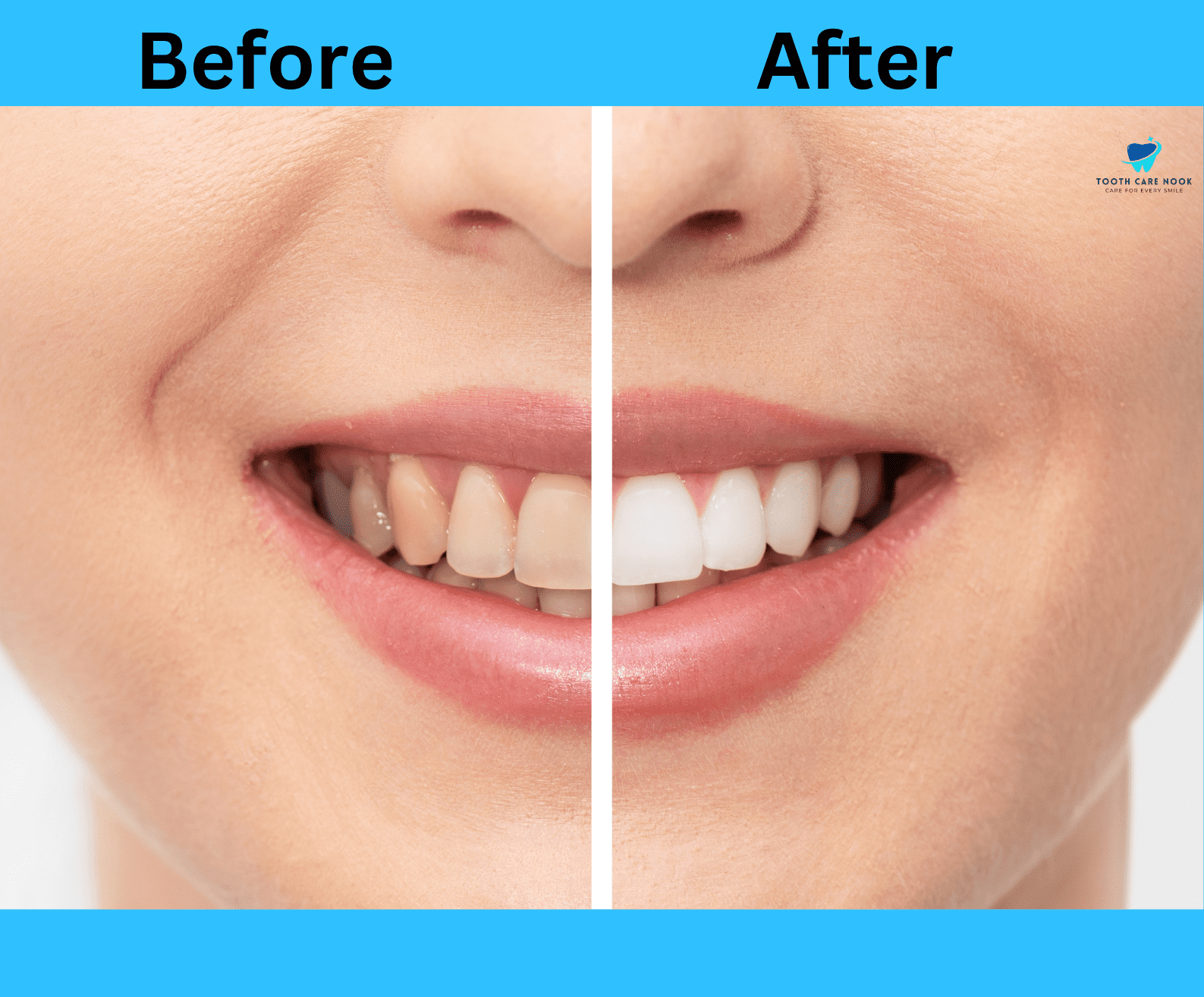 Internal Tooth Bleaching _ Before and After