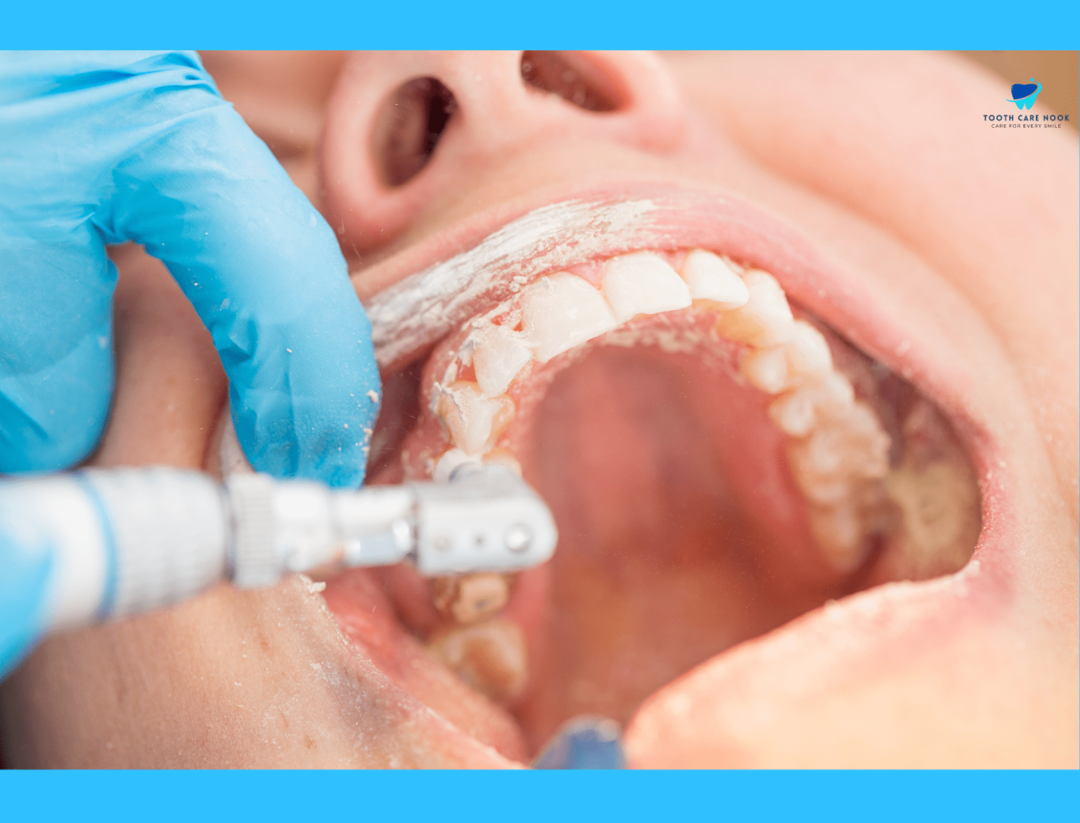 Back Teetch How Back Teeth Replacement is Done | All About Dental Implants