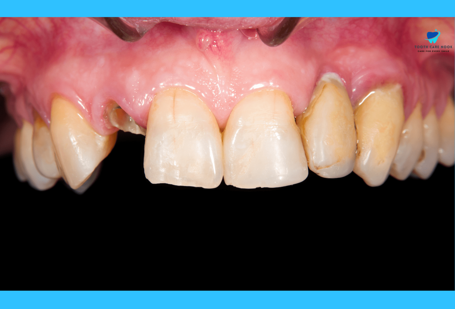 Role Of Ferrule In Preventing Failure Of Restorations  