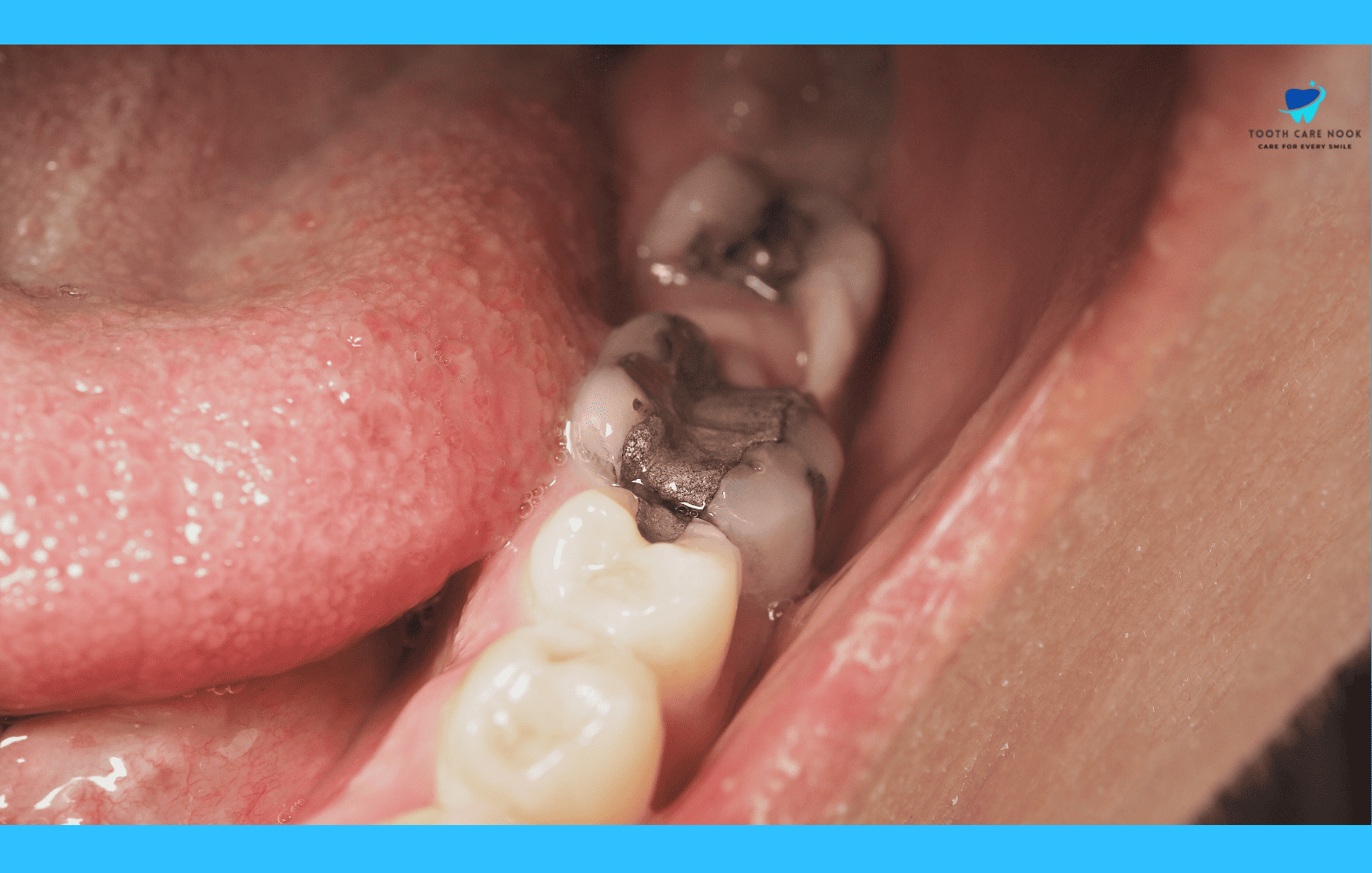 Stages Of Dental Decay