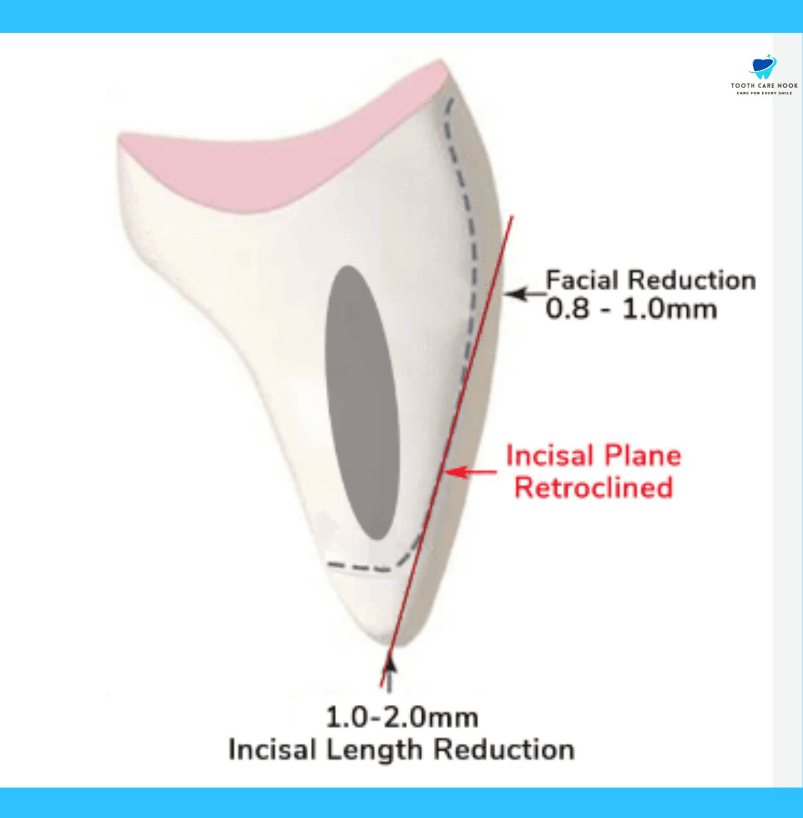 Veneer Prep Diagram 