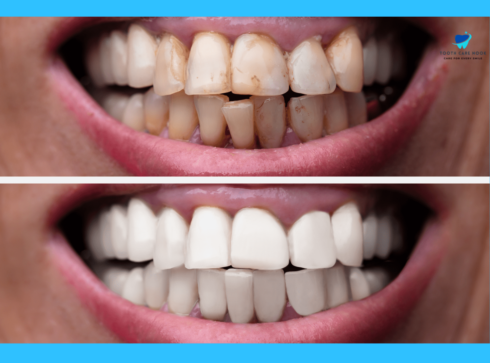 Veneers Before And After Shaved 