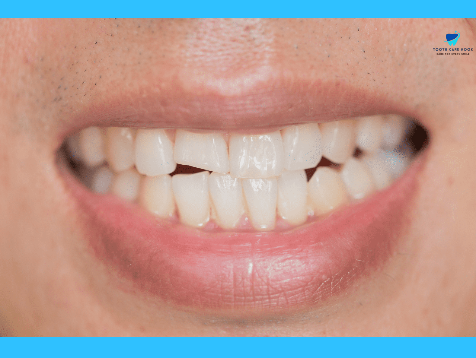 What Causes Hairline Cracks In Teeth   