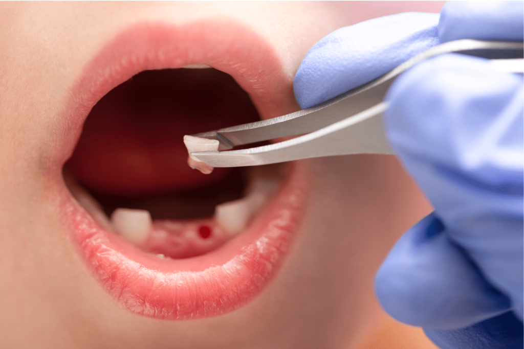 What Happens To The Abscess After Tooth Extraction