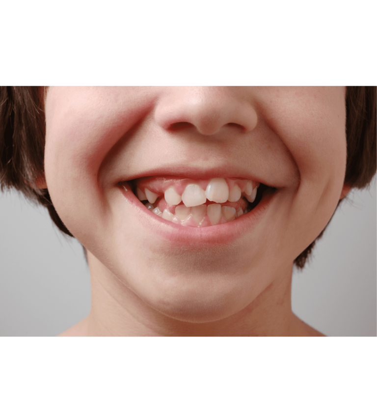 What Is Ankylosis Of Teeth