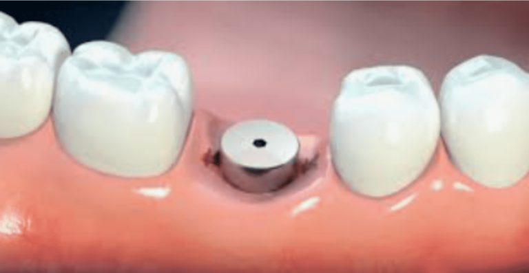 What Is Healing Caps For Dental Implants