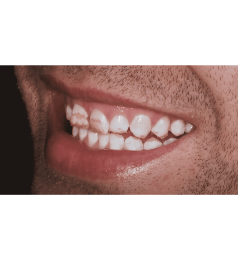 What is Hypocalcification Teeth