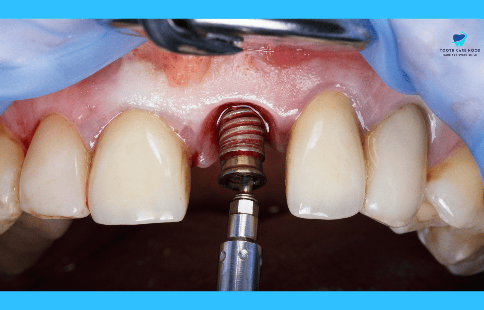 Why Are My Dental Implants Loosening