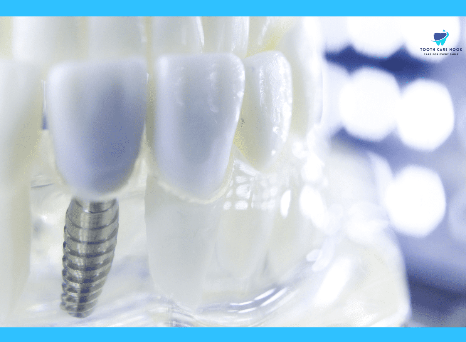 Advantages Of Titanium Dental Implant