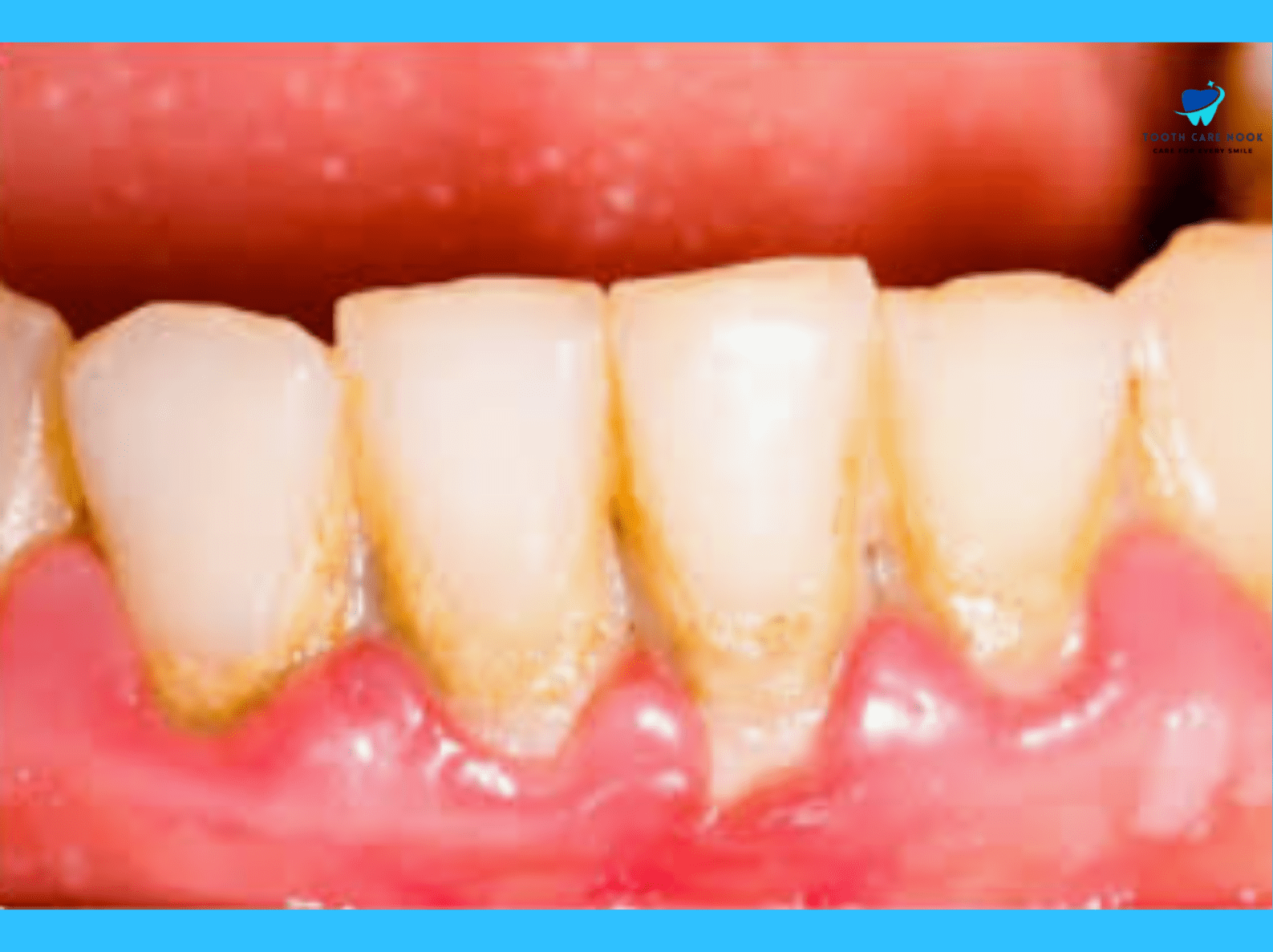 Causes Of Tartar Breaking Off Teeth