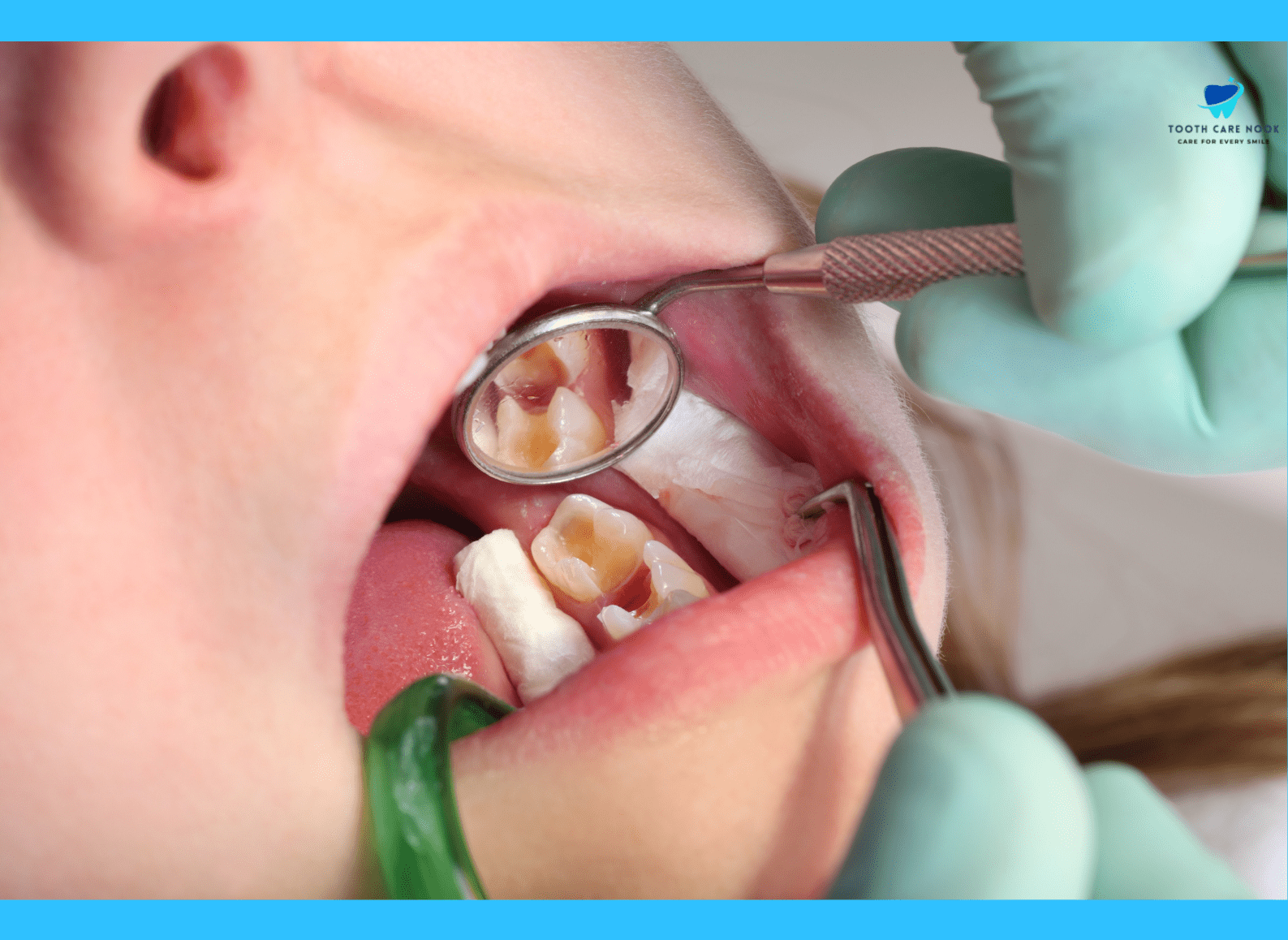 Impact Of Halitosis Wisdom Teeth On Long-Term Oral Hygiene  