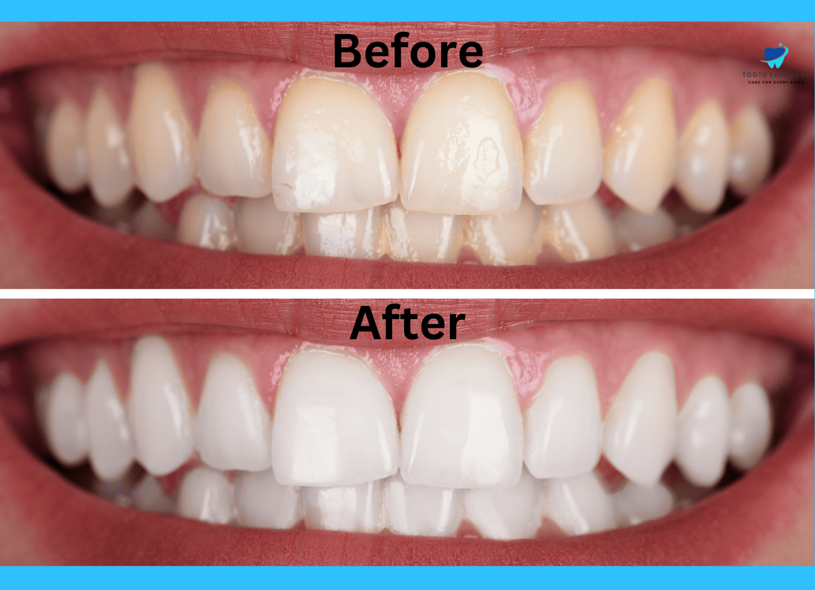 Invisalign Attachments Before And After