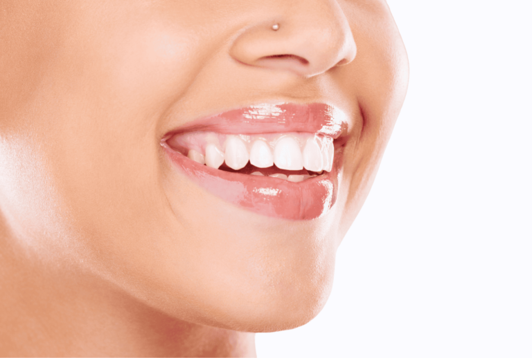 Invisalign buttons on teeth