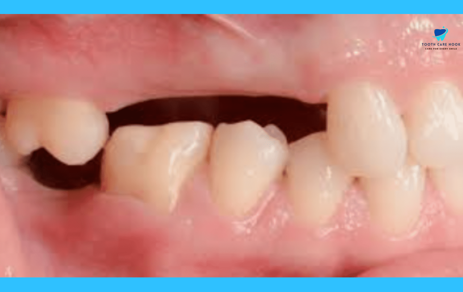 When To See A Dentist About Erupted Tooth