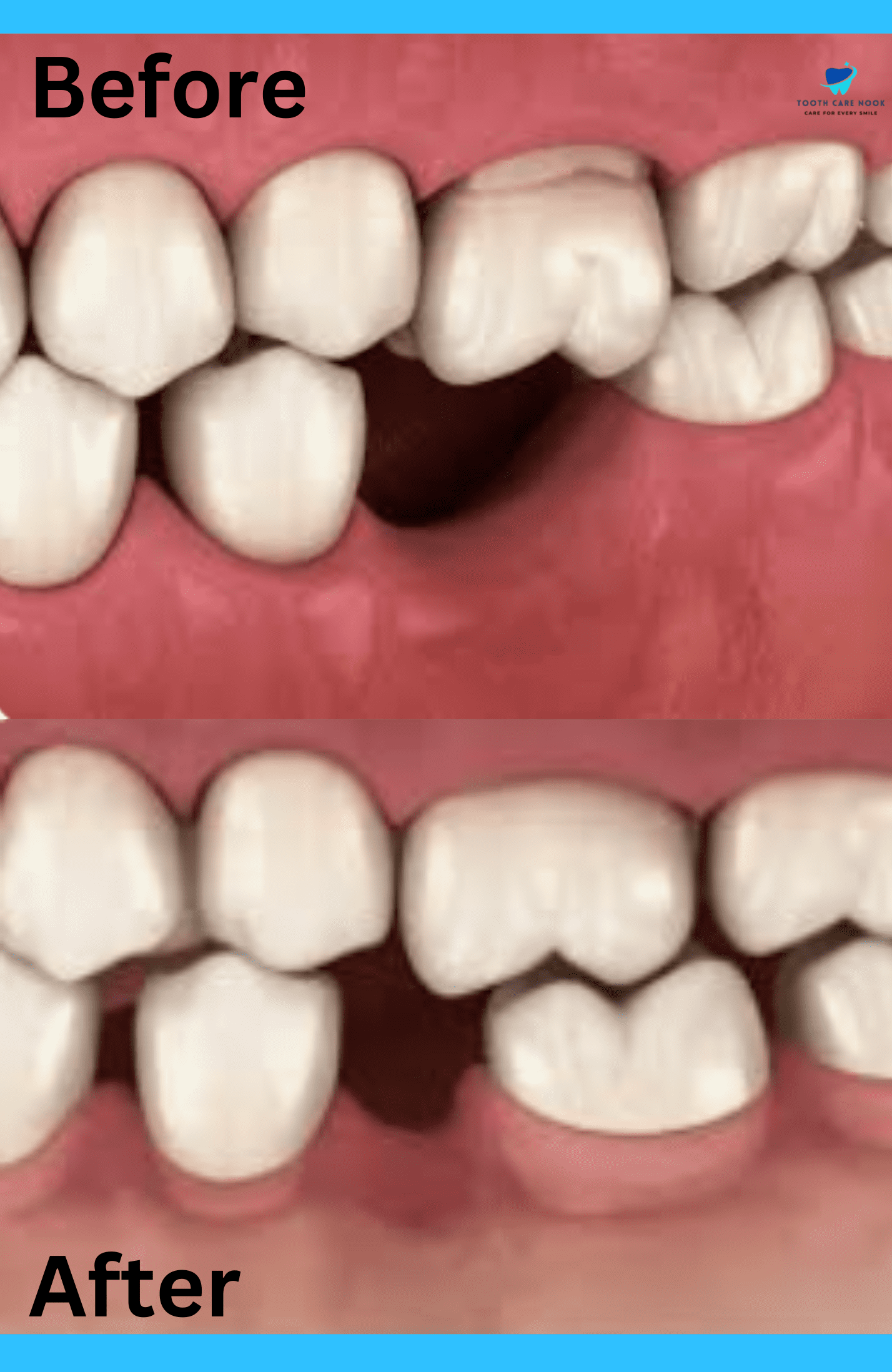 Teeth Shifting Before And After