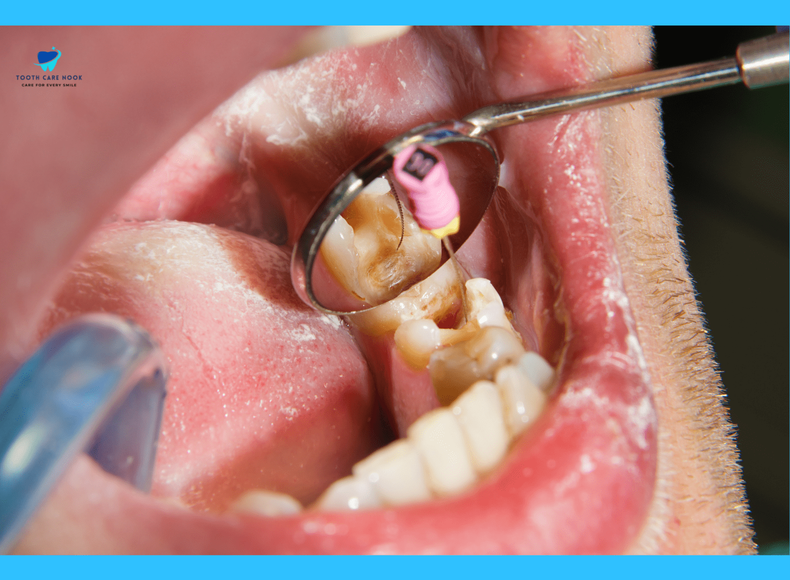 When To See An Endodontist? 