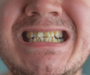 orange stain on teeth