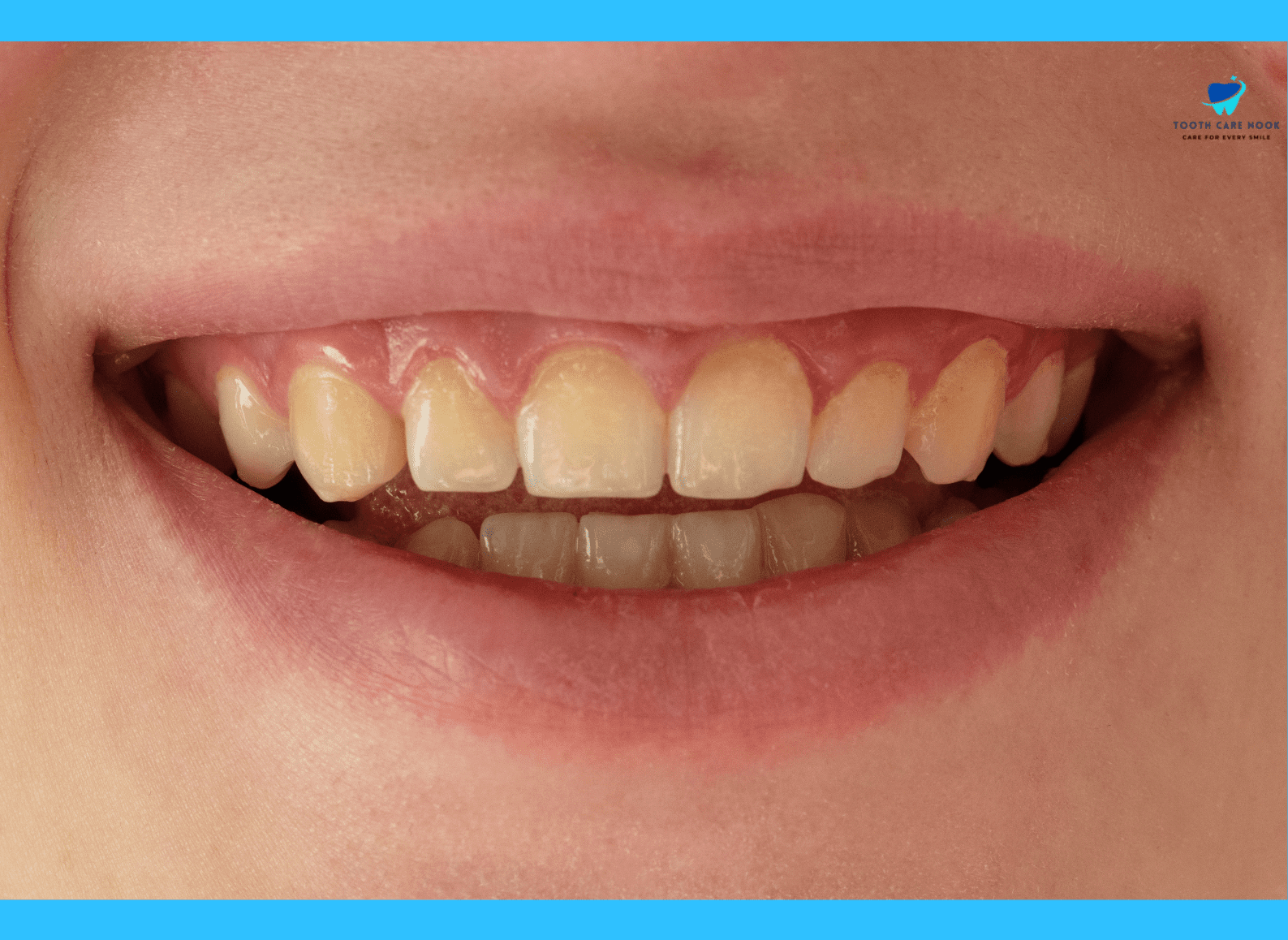 What Causes Iron Stained Teeth