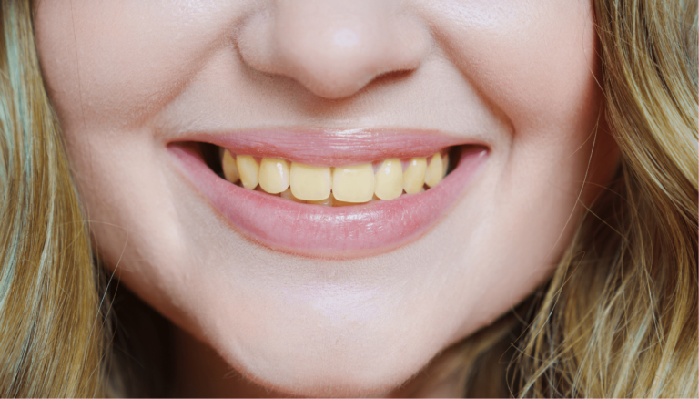 What Causes Iron Stained Teeth?