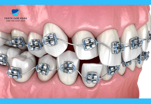 3D illustration of metal braces on teeth, showcasing their durable design and efficiency for complex dental corrections