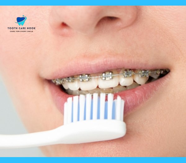 Close-up of a person brushing their teeth with ceramic braces, highlighting the importance of oral hygiene for clear braces