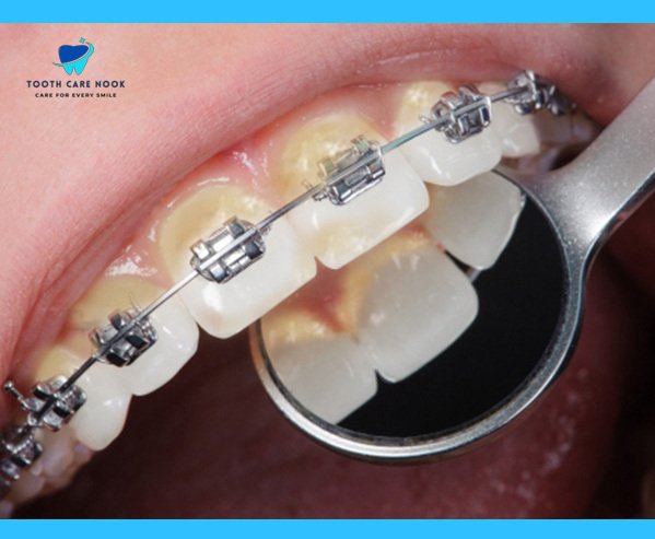 Close-up of ceramic braces showing staining on clear elastic bands with a dental mirror for inspection