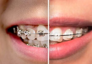 Close-up comparison of ceramic braces vs metal braces on teeth